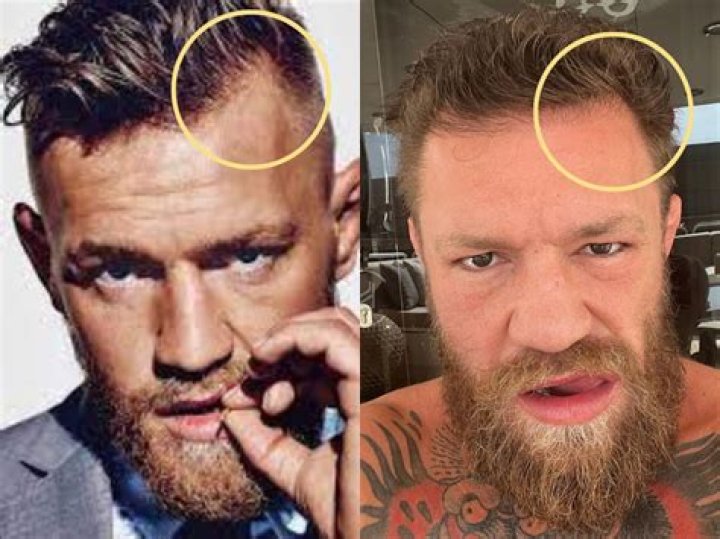 Did Conor McGregor Really Go Under The Knife? The Truth About His Plastic Surgery