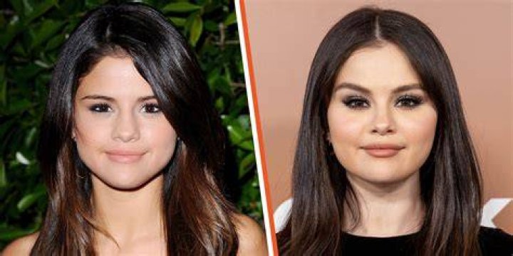 Selena Gomez's Journey: A Look At Her Transformations Before And After Surgery