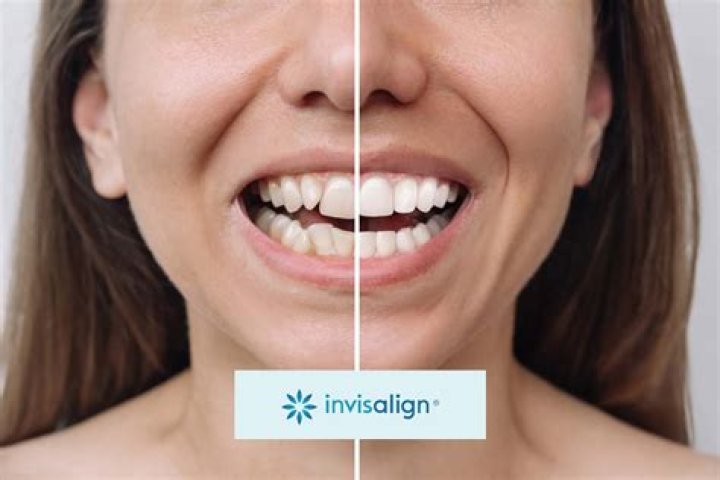 The Ultimate Guide To Teresa Giudice's Transformation: Before And After Teeth