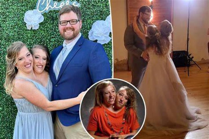 The Unbreakable Bond: Married Conjoined Twins Share Life And Love
