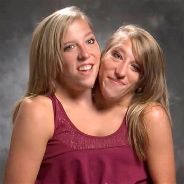 Tragic Passing: Conjoined Twins Abby And Brittany Succumb After Pregnancy