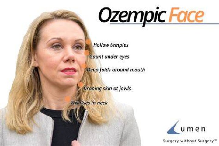 Uncovering The Effects Of Ozempic On Lupus: A Comprehensive Guide