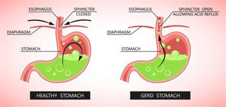 Understanding George Lopez Disease: Symptoms And Treatment Options