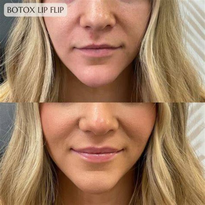 Zach Braff's Cosmetic Procedures: Exploring The Botox Effects